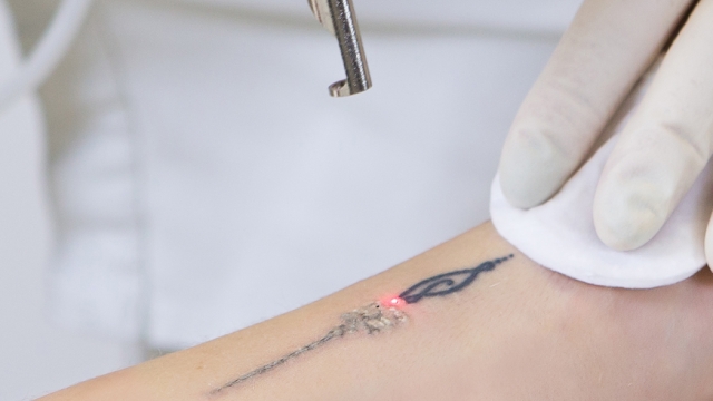 Gang Tattoo Removal – When Need To Deal With Want Gang Associations