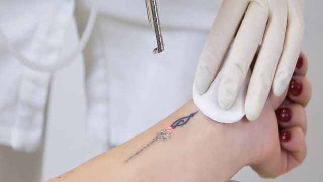 Four Facts You Absolutely Should Anticipate Before You Undertake Tattoo Laser Removal