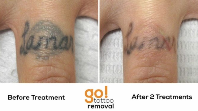 Popular Regarding Tattoo Removal