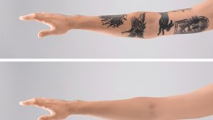 At Home Tattoo Removal As An Alternative Choice To Expensive Laser Removal Methods