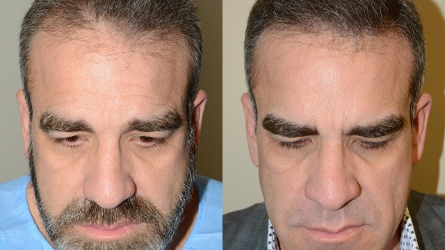 Unlocking Confidence: The Journey of a Hair Transplant