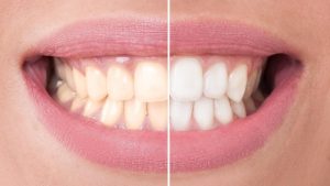 Beyond the Pearly Whites: Unveiling the Secrets of Teeth Whitening Products