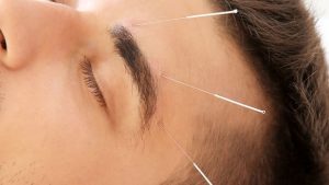 The Healing Power of Acupuncture: Unveiling Ancient Needles for Modern Wellness